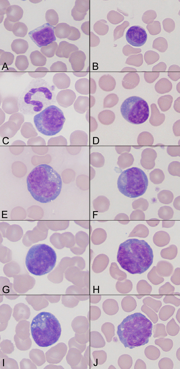 Microscope image: Lymphocytes: small and reactive